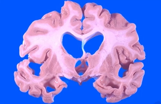 <p>appearance of increased CSF on imaging but is due to decreased brain tissue and neuronal atrophy</p><p>found in individuals with alzheimer’s disease, dementia, huntington’s disease</p><p>hydrocephalus mimics this (due to both having ventricles that appear to be larger than normal)</p>