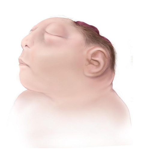 <ul><li><p>Normal event: Closure of the <strong><mark data-color="yellow" style="background-color: yellow; color: inherit;">anterior neuropore</mark></strong></p></li><li><p class="p1">Timing: Week 4 (days 23–26) of gestation</p></li><li><p class="p1">Failure leads to: <strong><mark data-color="yellow" style="background-color: yellow; color: inherit;">Absence of forebrain</mark></strong> (prosencephalon) → no cerebral hemispheres</p></li></ul><p></p>