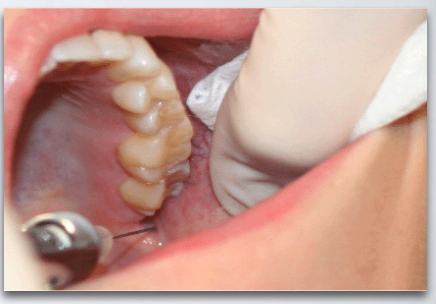 <ul><li><p>barrel of syringe in corner of mouth on opposite side</p></li><li><p>height of insertion = maxillary occlusal plane</p></li><li><p>needle tip just below ML cusp of maxillary 2nd molar + just distal to maxillary 2nd molar</p></li></ul><p></p>