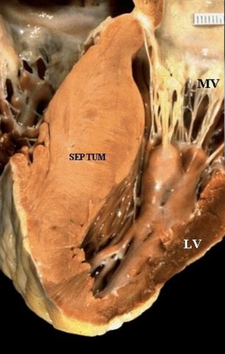 <p>AR Pompe disease II (lysosomal alpha-1,4-glucosidase deficiency)</p><p>Can't breakdown lysosomes to release glycogen in liver or muscle (PAS+)</p><p>Sudden death in young athletes</p><p>Differential: Myocete disarray (B-myosin heavy chain or myosin-binding protein C mutation)</p><p>Tx: replace enzyme</p>