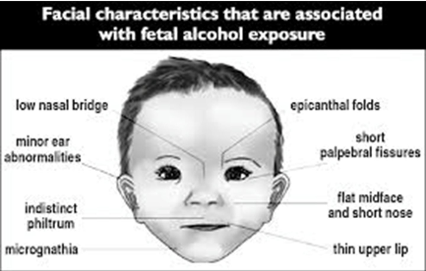 <p>- Low-set ears.</p><p>- Broad nasal bridge.</p><p>- Irregular teeth.</p><p>- Hypoplastic nails and digits.</p><p>BUT epilepsy itself is associated w/increased risk of congenital abnormalities.</p>