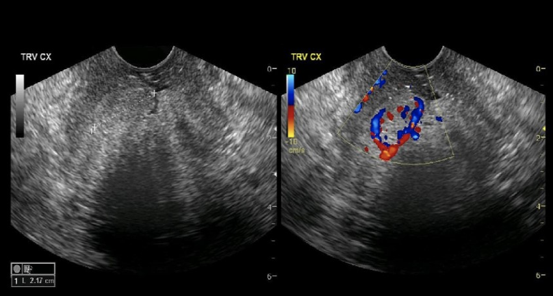 <p>chronic pelvic inflammatory disease can lead to</p><p>a) emergency hysterectomy</p><p>b) emergency salpingectomy</p><p>c) formation of cervical polyps</p><p>d) formation of uterine septum </p>