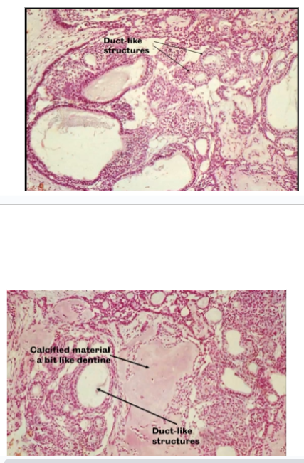 <p>Epithelial Cells forming sheets and Duct-Like Structures.</p><p>Calcification is common</p>
