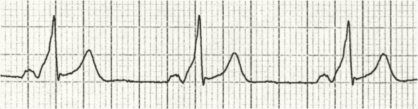<p>Delta waves</p>