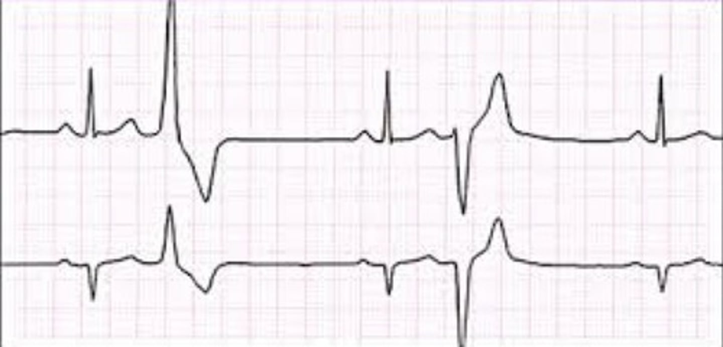 <p>What does the ECG show?</p>