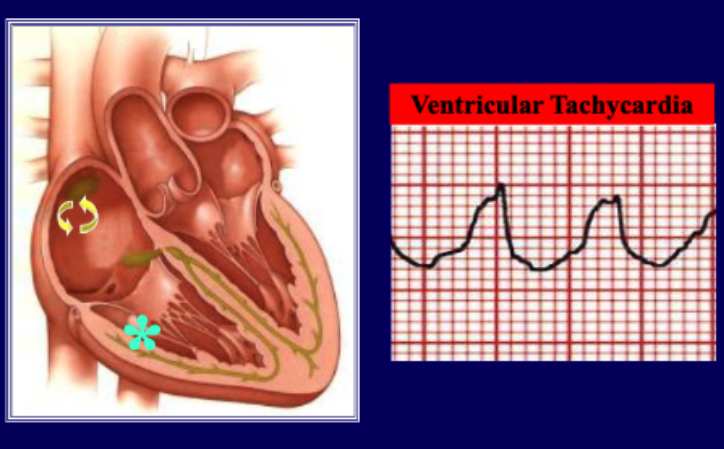 <p>ventricular tachycardia</p>