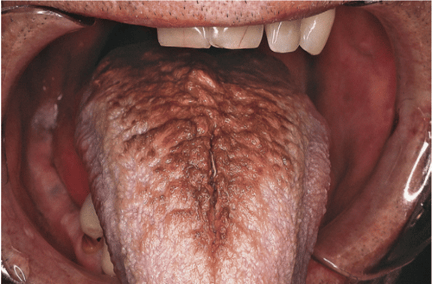 <p>elongation of filiform papillae and painless overgrowth</p>