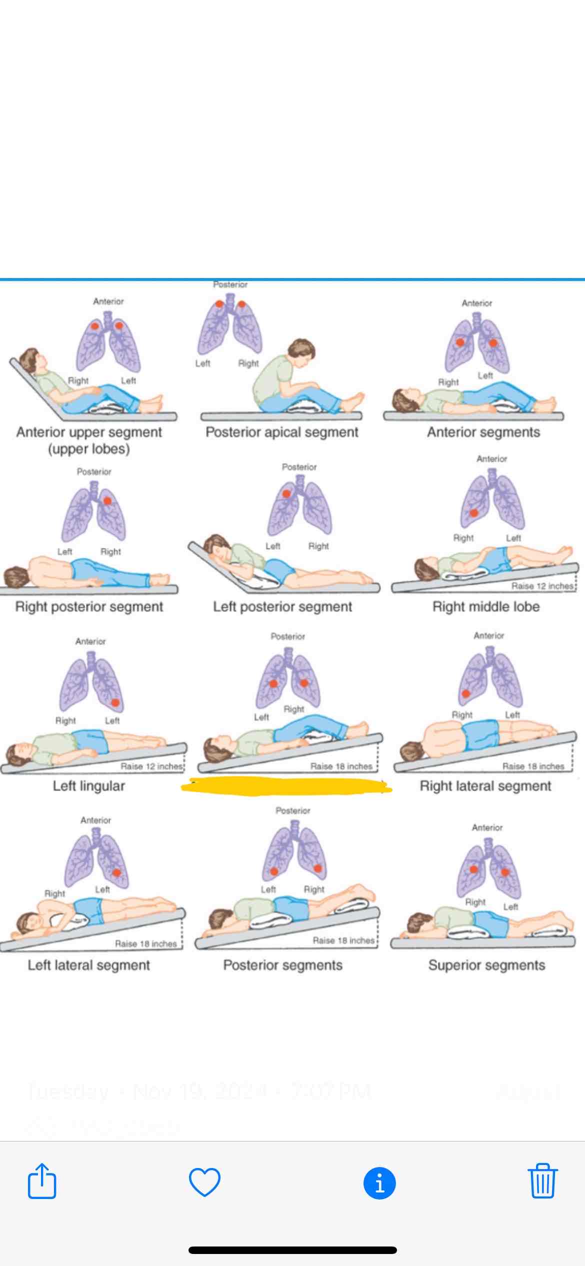 <p><span>Which lung segment does this position effect</span></p>