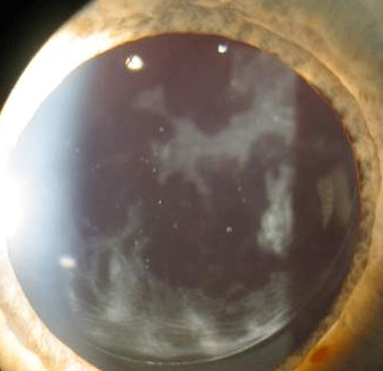 <p>Posterior capsular opacity</p>