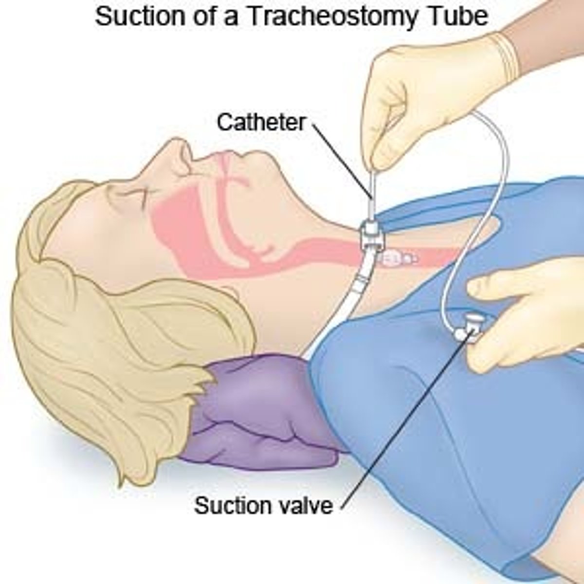 <p>-Keep the following at the bedside: Two extra tracheostomy tubes (one the client’s size and one size smaller, in case of accidental decannulation), the obturator for the existing tube, an oxygen source, suction catheters and a suction source, and a BVM.</p><p>-Provide methods to communicate with staff (paper and pen, dry‑erase board).</p><p>-Give oral care every 2 hr.</p><p>-Provide tracheostomy care every 8 hr to reduce the risk of infection and skin breakdown.</p><p>-<strong>Apply intermittent suctioning ONLY when removing the catheter…NOT when inserting!</strong></p><p>-<strong>You will really hurt them if you apply suction while going down!</strong></p><p>-Use medical asepsis for suctioning the mouth.</p><p>-<strong>Use</strong> <strong>surgical asepsis for all other types of suctioning.</strong></p><p>-Use suction pressure no higher than 120 to 150 mm Hg.</p><p>-Limit each suction attempt to no longer than 10 to 15 seconds to avoid hypoxemia and the vagal response. Repeat suctioning if needed. Limit total suctioning time to 5 minutes.</p><p>-Suctioning is PRN…Coughing, crackles, decreased pulse ox, etc.</p><p>-When you suction you “steal” their oxygen, so it is NOT done “just because.”</p>