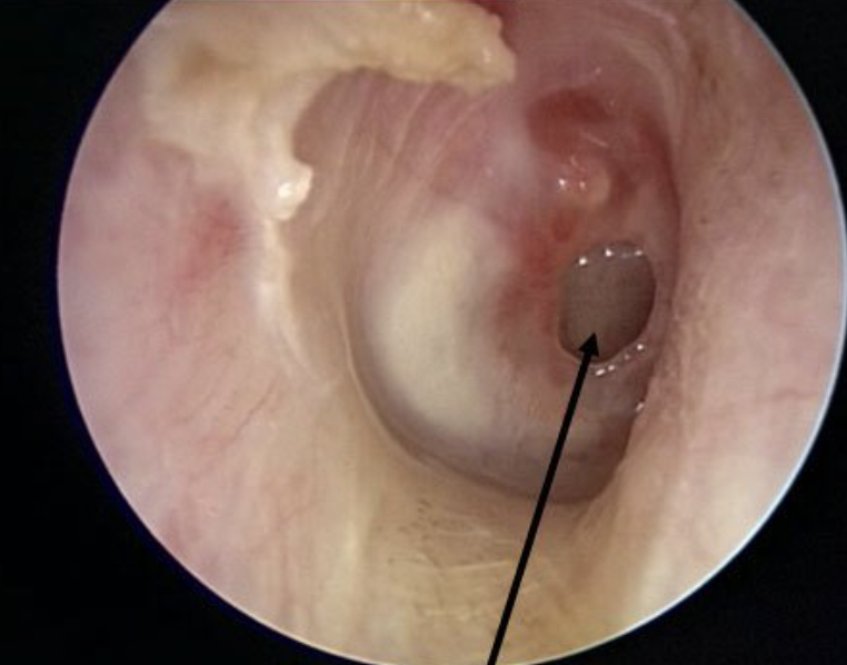 <p>Ruptured tympanic membrane; a dark oval, hole will be present in the membrane</p>