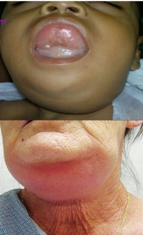 <p><strong>Symptoms of Ludwig’s Angina</strong></p><p>-______ and erythema across submandibular area. Found mostly on the upper neck under the _____ and the ______ of the mouth </p><p>-Tongue may be ________ upward and backward</p><p>-Neck pain, stiffness</p><p>-Fever, chills, malaise </p><p>-Can lead to ________ of airway</p>