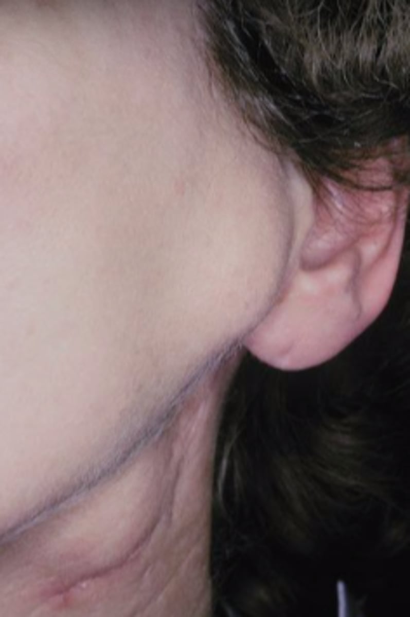 <p>Malignant Salivary Gland Tumors: </p><p>-Malignant transformation of a PA(pleomorphic adenoma)!</p><p>-Middle aged and older</p><p>-History of a lesion present</p><p>for many years</p><p>-Rapid growth</p><p>▫ pain, ulceration</p><p>▫ facial nerve palsy</p><p>-Most in parotid</p><p>-Minor SG→ most on</p><p>palate</p>