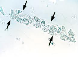 This cast signifies infection or inflammation within the nephron; pyelonephritis (upper UTI)
