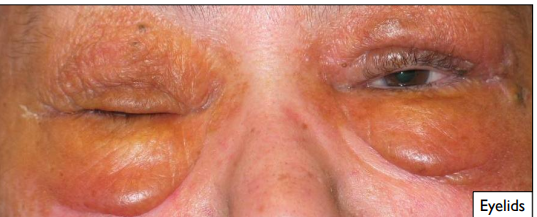 <p>extra-oral: eyelid, neck, lips </p>