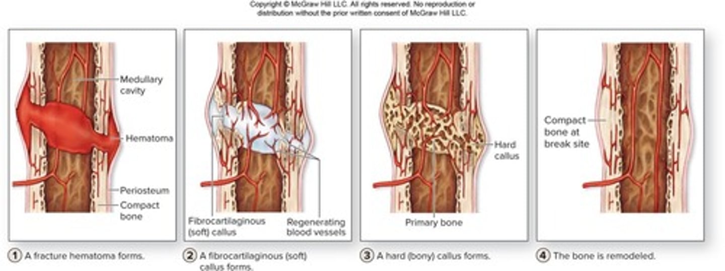 <p>1. A fracture hematoma forms, 2. A fibrocartilaginous (soft) callus forms, 3. A bony (hard) callus forms.</p>