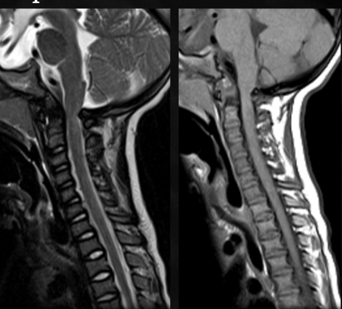 <p>what is seen here for this case of achondroplasia?</p>