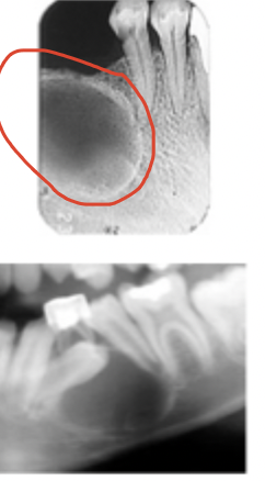 <p>The lesion exhibits a thin well-demarcated radiopaque rim of bone at the periphery. Usually indicative of a benign slow growing process. </p>