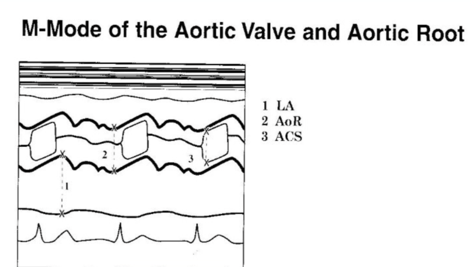 <p>1. LA end systole dimension</p><p>2. AoR dimension at end diastole</p><p>3. ACS - Aortic valve systolic separation</p>