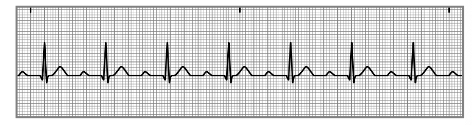 <p>is a condition where there is a prolonged delay in the conduction of electrical impulses from the atria to the ventricles, often observed on an EKG as a longer than normal PR interval. </p>