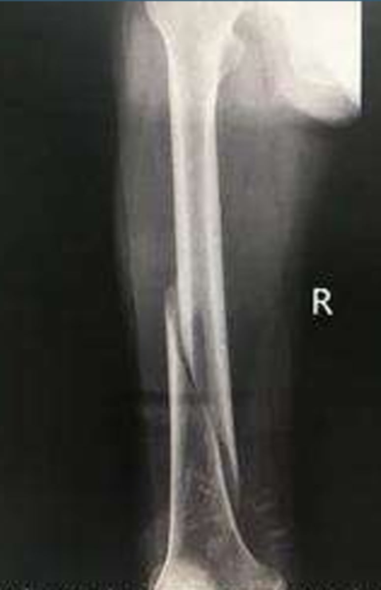 <p>What type of fracture is this?</p>