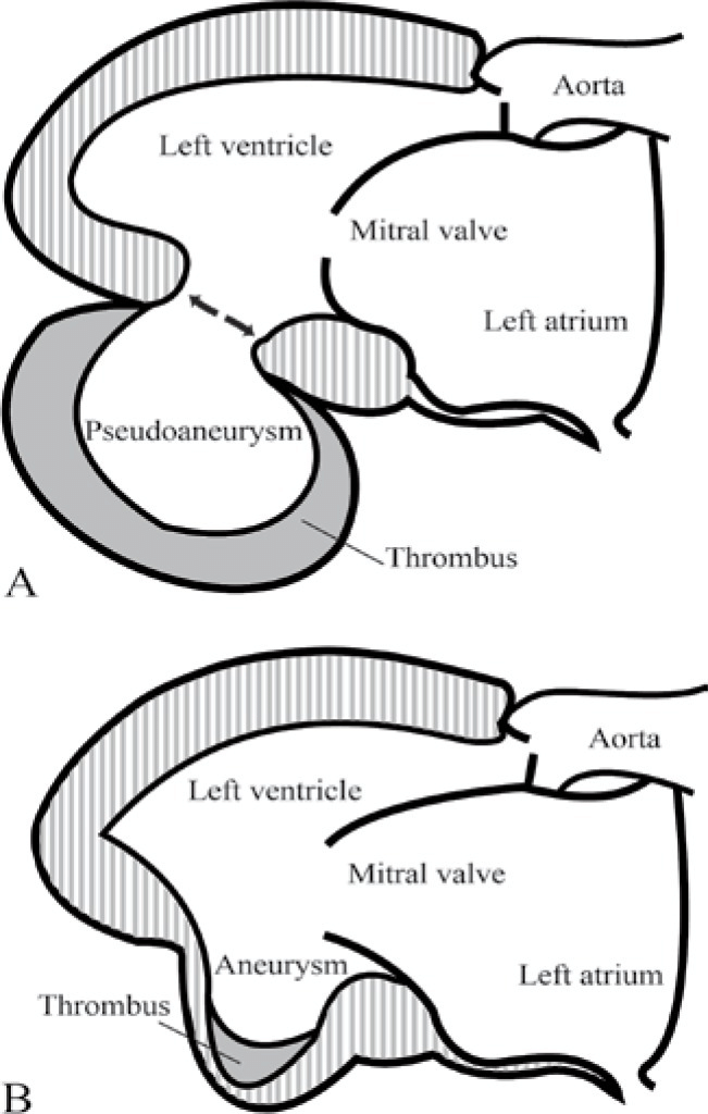 <p>Localized, full-thickness bulge of the heart wall that is still intact, but weakened.</p><p>Surrounded by myocardial tissue.</p>