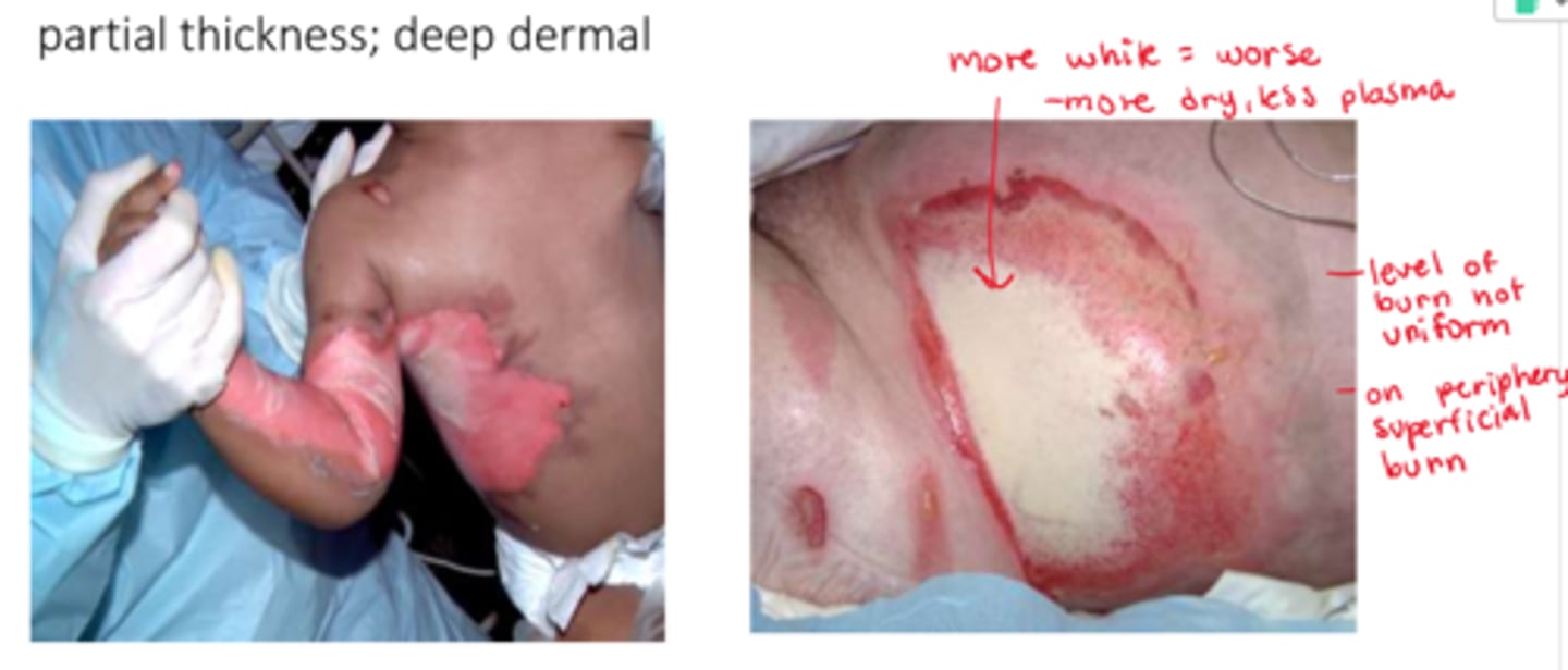 <p>- that it is WORSE, further into the dermis (will be drier/more waxy)</p>