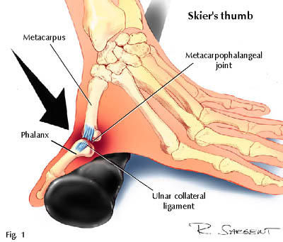 <p>-rupture of ulnar collateral ligament of MCP of thumb</p><p><span data-name="high_voltage" data-type="emoji">⚡</span>️Go skiing in Utah (skier’s=UCL tear)<br>-OT int: thumb splint (4-6wk), start with gentle AROM at 2-4 wks, then AAROM/lateral pinch strengthening with doc approval (6-12 wks post-op)</p>