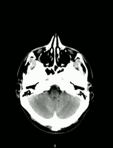 <p>What Part of Brainstem?</p>