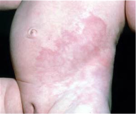 <p><strong>What skin condition is a vasomotor response to cooling or chronic exposure to radiant heat that appears lattice like, bluish mottled pattern on trunk, arms, &amp; legs?</strong></p>