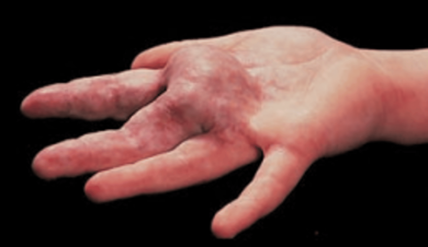 <p>Localized collection of blood creating an elevated ecchymosis.</p>