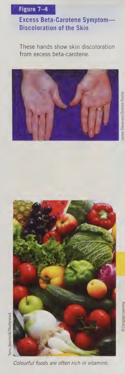 <ul><li><p>it has been known to turn people’s skin bright orange/yellow</p></li><li><p>beta carotene builds up in the fat beneath the skin</p></li><li><p>this looks alarming, however is harmless</p></li><li><p>concentrated beta carotene supplements may have adverse effects however, such as increased risk of lung cancer in those who smoke</p></li></ul><p></p>