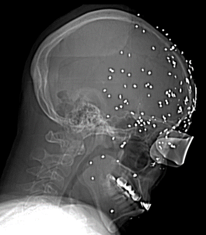 <p>Diagnosis? Causative instrument?</p>