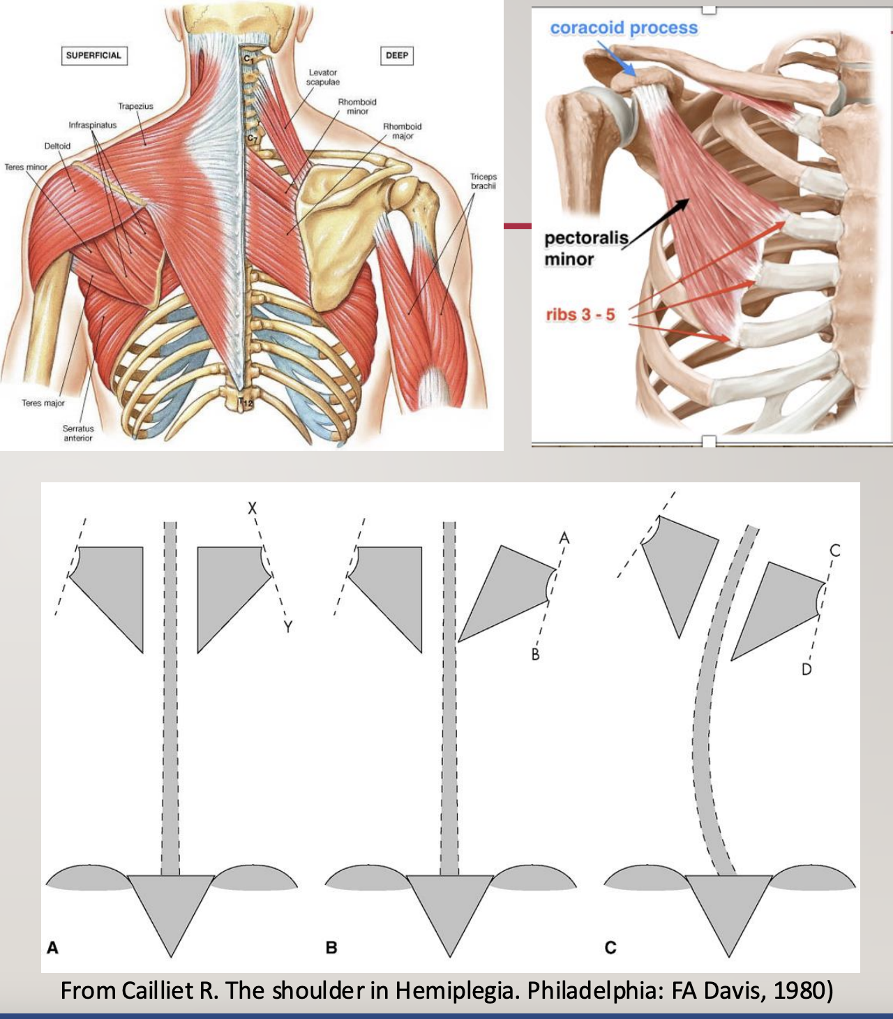 <ol><li><p><strong><u>Resting position of scapula</u></strong> (i.e., <strong><u>appropriate alignment</u></strong>)</p></li><li><p><strong><u>Function of the scapula</u></strong>:</p><ol><li><p><strong><u>stability,</u></strong></p></li><li><p><strong><u>support overhead motions,</u></strong></p></li><li><p><strong><u>glides to prevent impingement</u></strong></p></li></ol></li><li><p><strong><u>Why does scapula fall out of alignment?</u></strong></p><ol><li><p><strong><u>Weakness in scapula</u></strong></p><ol><li><p><strong><u>of upper traps, of lower traps, etc.</u></strong></p></li></ol></li><li><p><strong><u>Muscle imbalance around the scapula</u></strong></p></li><li><p><strong><u>Trunk mal-alignment </u></strong>(B in photo)</p></li><li><p>Usually, <strong><u>downward rotation, “tipping”, and winging</u></strong></p><ol><li><p><strong><u>due to a problem with the serratus anterior</u></strong></p></li></ol></li></ol></li><li><p><strong><u>What to look for?</u></strong></p><ol><li><p><strong><u>scapula</u></strong></p></li><li><p><strong><u>vertebrae</u></strong></p></li><li><p><strong><u>pelvis&nbsp;</u></strong></p></li></ol></li></ol><p></p>