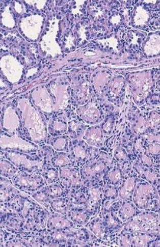 At 40 weeks' gestation, a 20-year-old woman delivers a healthy infant and begins nursing postpartum. Her breasts show bilateral enlargement. The microscopic appearance of her breast tissue is shown. What is the morphologic description? What is the substance represented by the pink-staining material within the lobules? What hormonal stimuli account for these findings? 