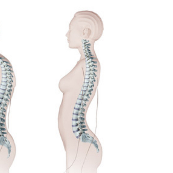 <p>(arched bsck) </p><p>Exaggeration of lumbar curve</p><ul><li><p>Increased abdominal weight </p></li></ul>