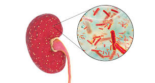 <p><strong>A nurse in an acute medical unit of a hospital has admitted a 62-year-old female from the emergency department who has been diagnosed with acute pyelonephritis. Which of the following statements most accurately conveys an aspect of the knowledge base that the nurse needs to perform adequate care and teaching?</strong></p><p>A) Most cases of acute pyelonephritis are attributable to poorly controlled hypertension.</p><p>B) Flank pain, dysuria, and nausea and vomiting are likely assessment findings.</p><p>C) The infection in the kidney is most likely a manifestation of a systemic infection.</p><p>D) Imaging tests are likely to reveal scarring and deformation of the renal calices and pelvis.</p>