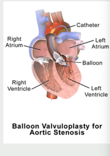 <p>Aortic Balloon Valvuloplasty</p><p>Only provides < 6 months of AS</p><p>relief</p>
