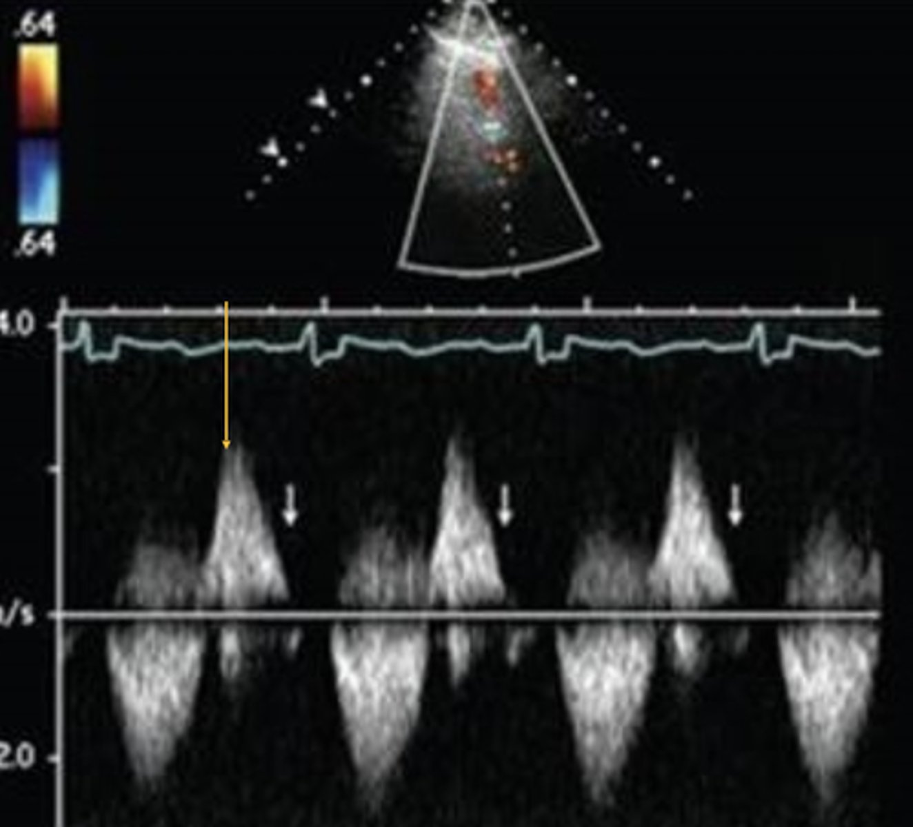<p>Indicates severe PR</p>