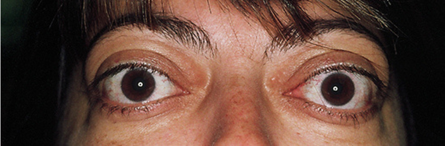 <p>bilateral proptosis </p>