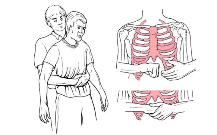 <p>Abdominal; umbilicus; xiphoid process</p>