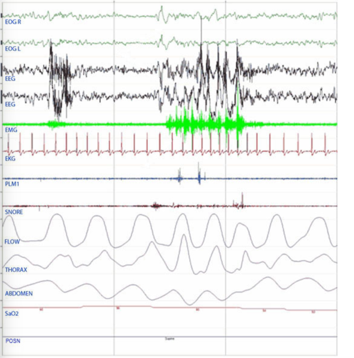 <p>The following 30 second epoch is observed. Which of the following is most consistent with these findings? </p>