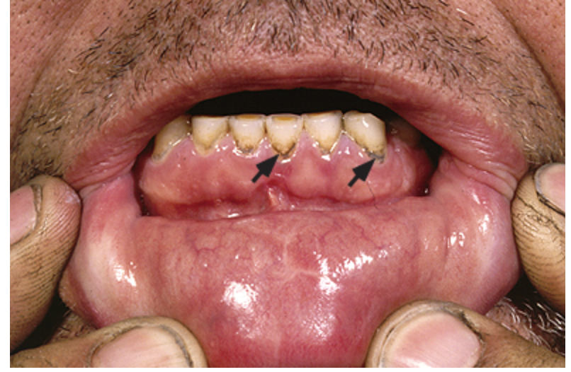 <p>Features of Lead poisoning</p>