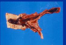 <p><span>Arterial thrombosis in Horses</span></p>