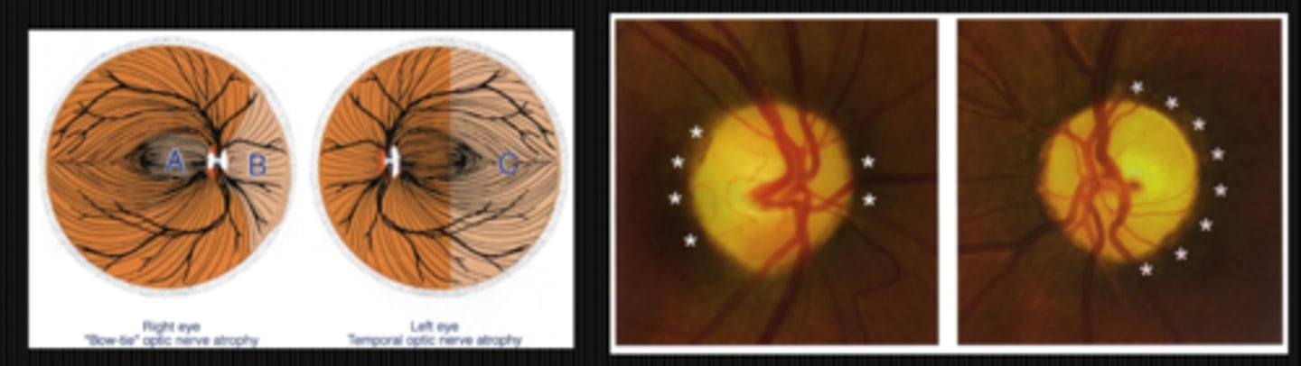 <p>fibers from temporal retina entering OS ONH</p><p>fibers from nasal retina entering OD ONH</p><p>papillomacular bundles of the OD ONH</p>