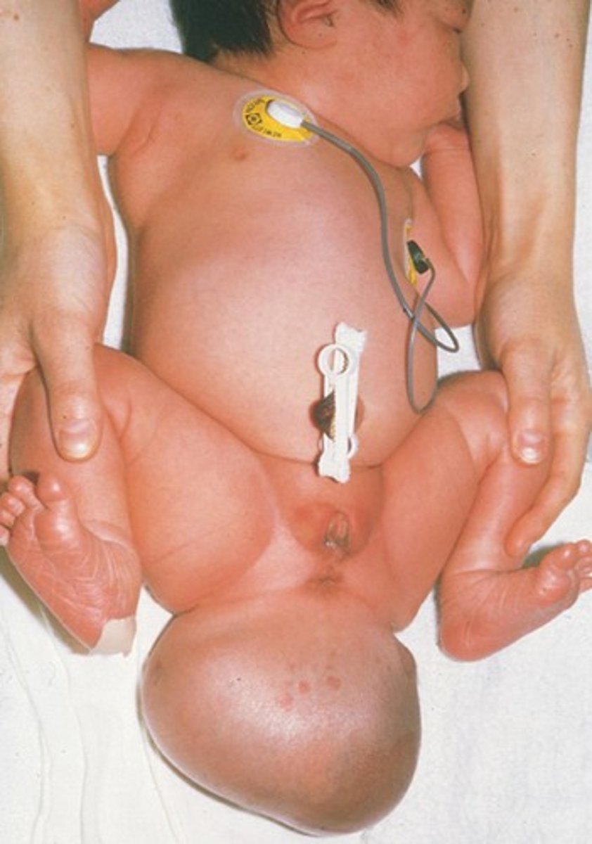<p>Remnants of the primitive streak that persist after birth, contains tissues derived from all three germ layers in incomplete stages of differentiation:</p>