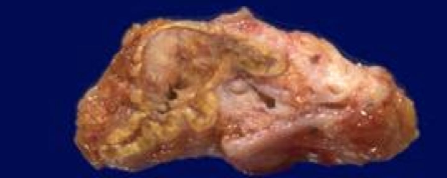 <p>Define Cause of Primary Adrenocortical Insufficiency:</p><p>Cancer spread to adrenals from LUNG or BREAST cancer</p>