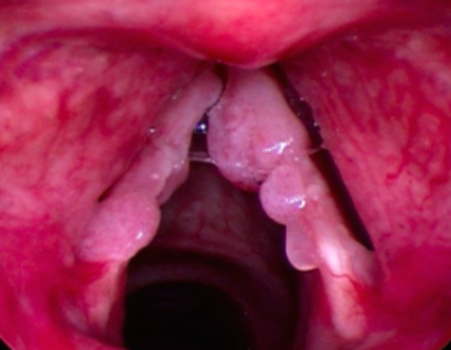 <p>constant surgery removal (benign)</p>