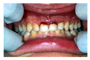 <p><span style="background-color: transparent;"><span>Injury to supporting tissues with NO loosening or displacement of the tooth.</span></span></p><p><span style="background-color: transparent;"><span>TTP, Bleeding or bruising at gingival margin</span></span></p>