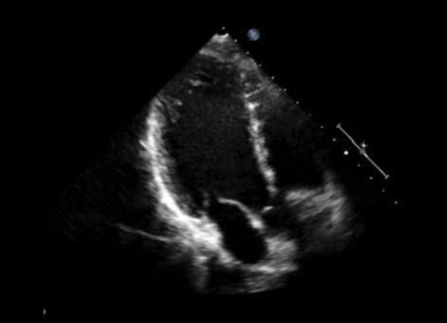 <p>anterior mitral valve leaflet</p>